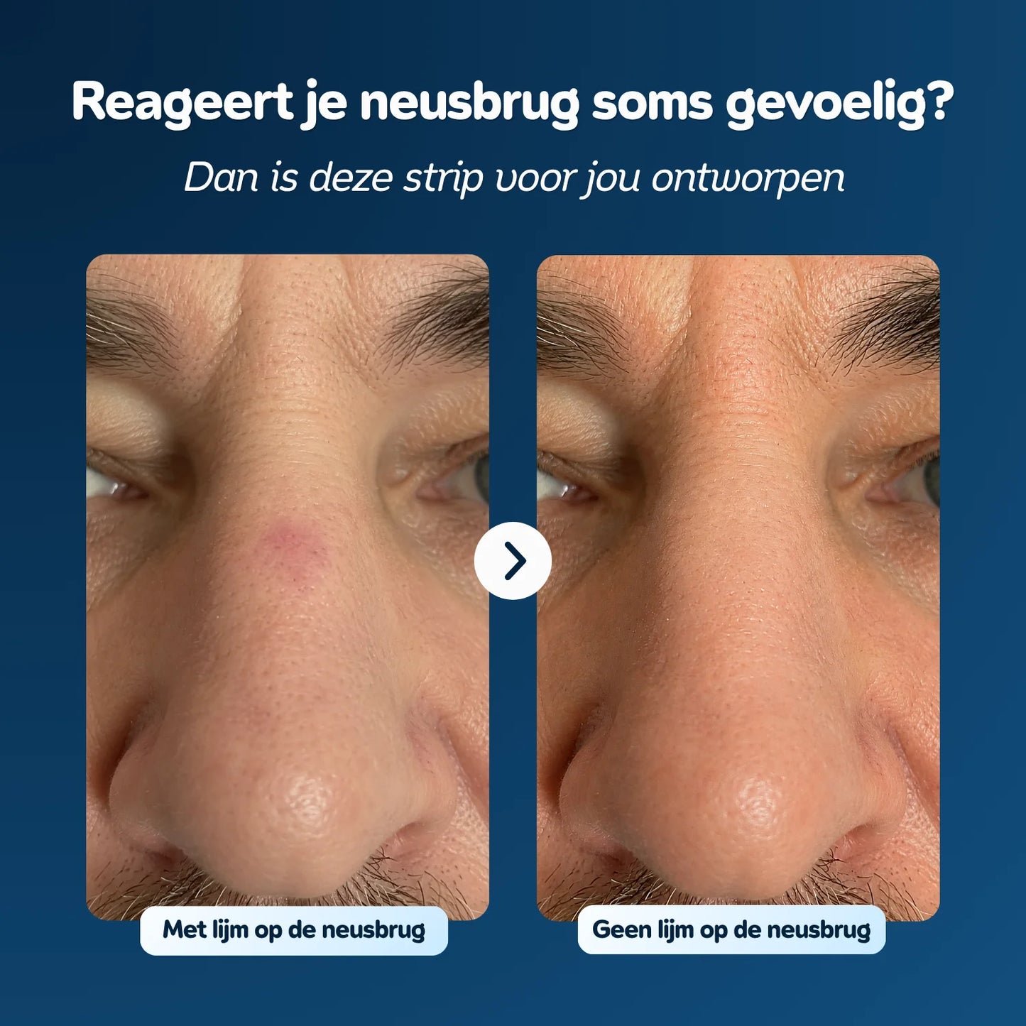 Neusstrips | Voor gevoelige huid